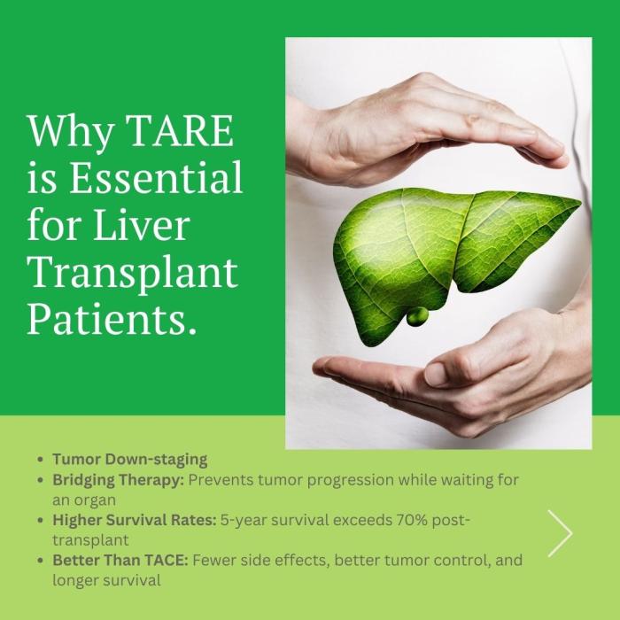 TARE for liver cancer, Transarterial radioembolization liver transplant, Yttrium-90 treatment for HCC, Liver cancer downstaging for transplant, TARE vs TACE for hepatocellular carcinoma, Bridging therapy for liver transplant, Radioembolization survival rates post-transplant, Cost-effectiveness of TARE for liver cancer, Y-90 therapy for liver cancer patients, HCC treatment before liver transplantation, Dr. Ishita B Sen