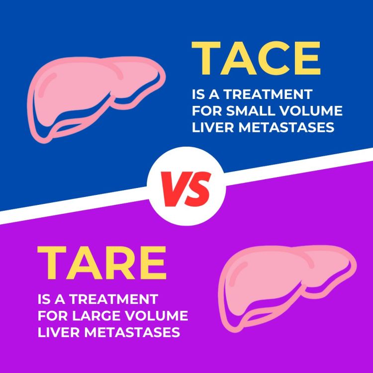 Transarterial Radioembolisation, Transarterial Chemoembolization, TACE vs TARE, Transarterial Radioembolisation in India, Side Effects of TARE, Nuclear Medicine Expert in India